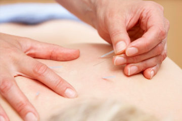 Acupuncture