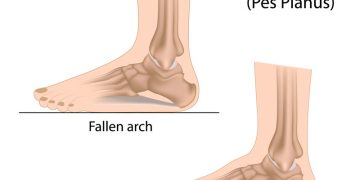Does Your Child Have Flat Feet? Physio Techniques for Pediatric Pes Planus