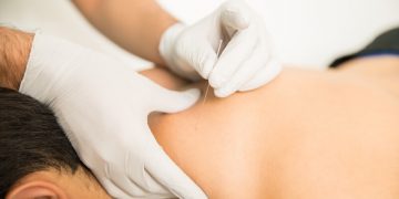 What to Expect at Your Integrated Dry Needling Treatment  